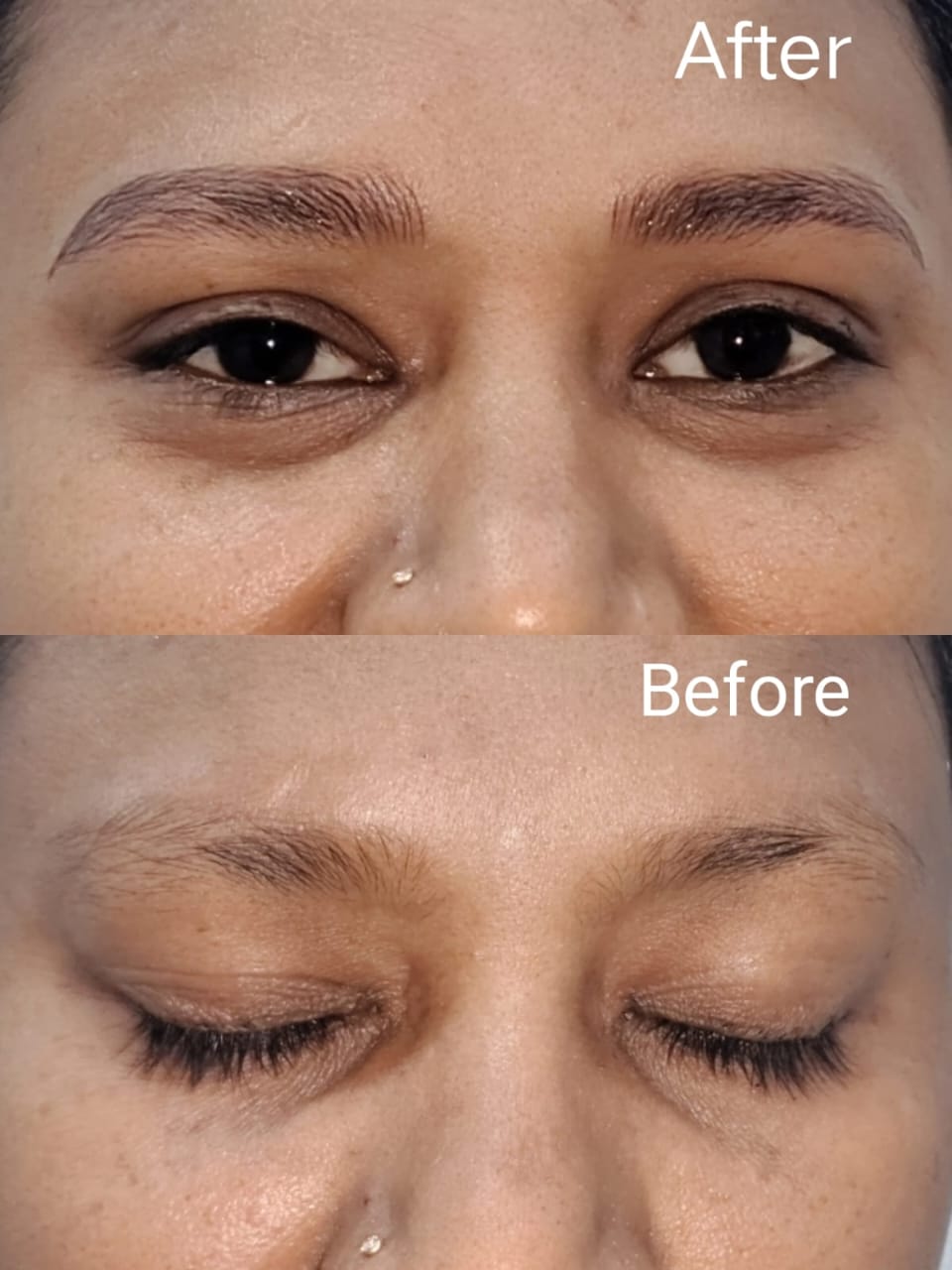 Hair Transplant Testimonial